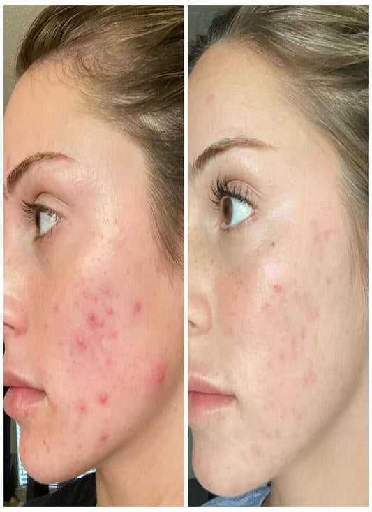 Dr Taffi Glycolic Acid Acne Treatment Bundle - Bahja Care